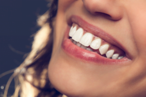 Transform Your Smile With Veneers