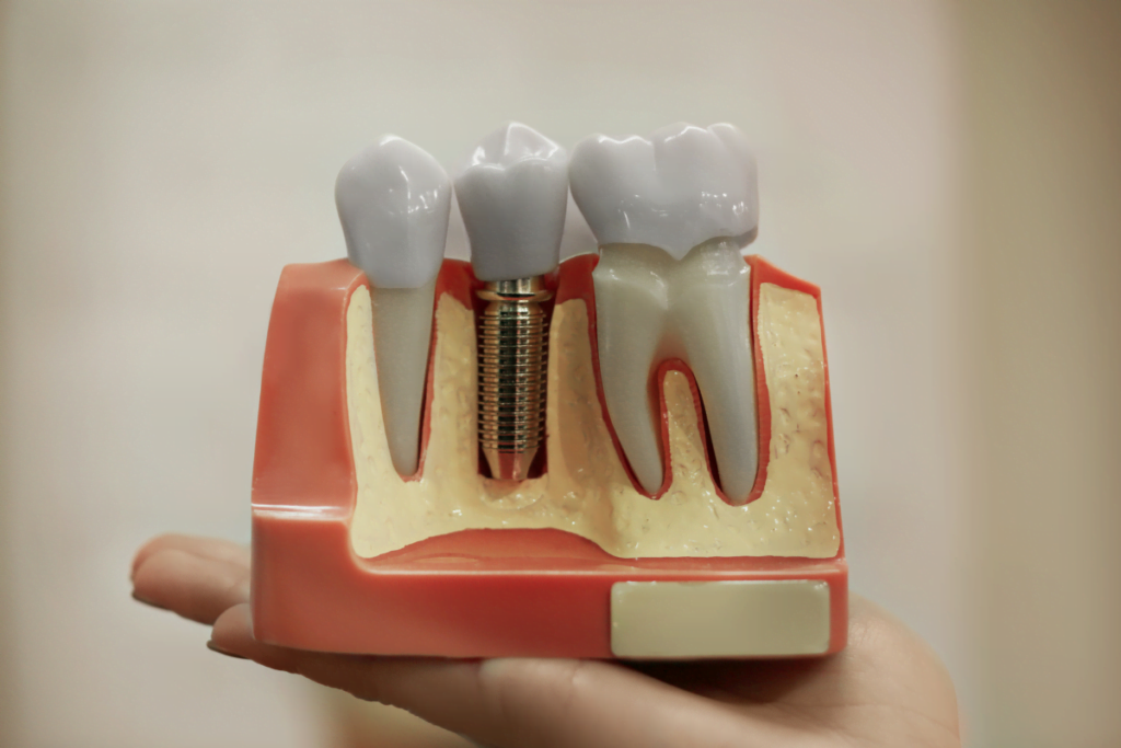 Dental Implants - Miners Ravine Dental Group
