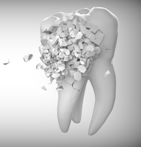 Why is a Cracked Tooth a Dental Emergency?