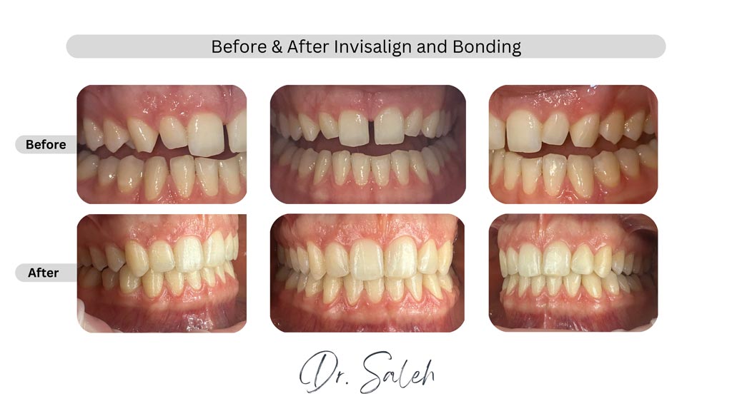 Before and After - Invisalign and Bonding