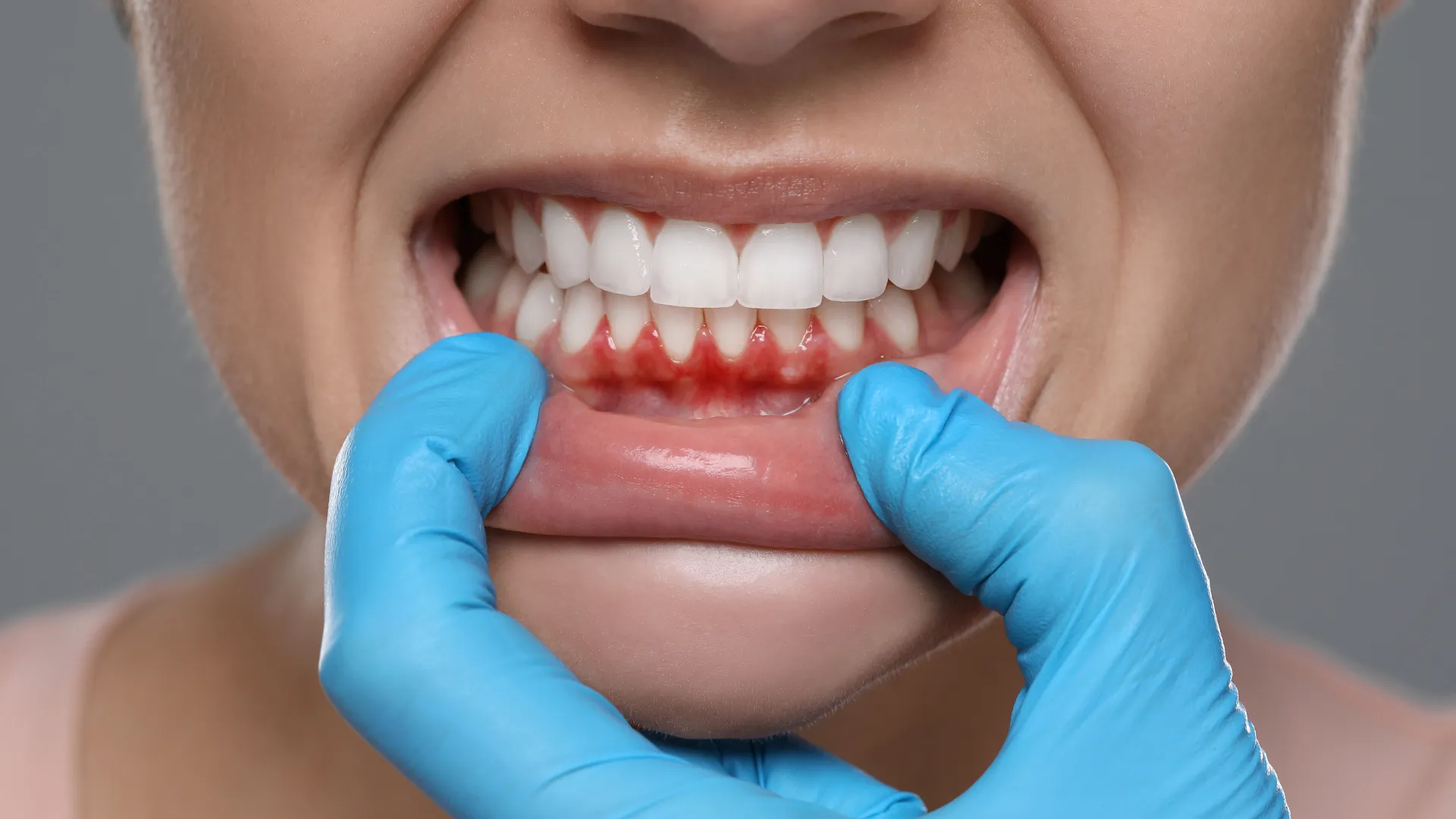Close-up of red, swollen gums, a common symptom of early stage gum disease.